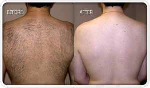 permanent-hair-removal